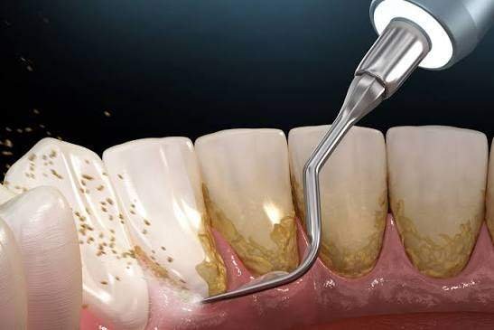 How to Choose the Right Teeth Whitening Clinic for You
